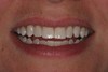 Smile Gallery Dr. Nicholas Cox Dr. David Toney Cox Family Dentistry General, Cosmetic, Restorative, Preventative, Family Dentistry in Allen, TX 75002