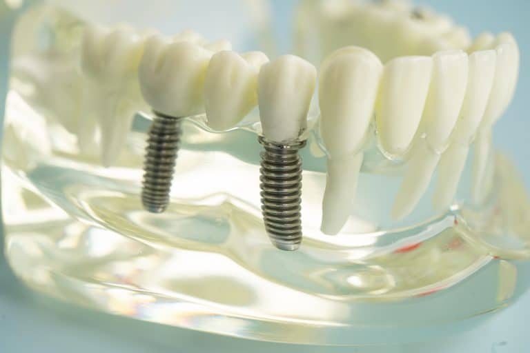 Dental Implants Allen